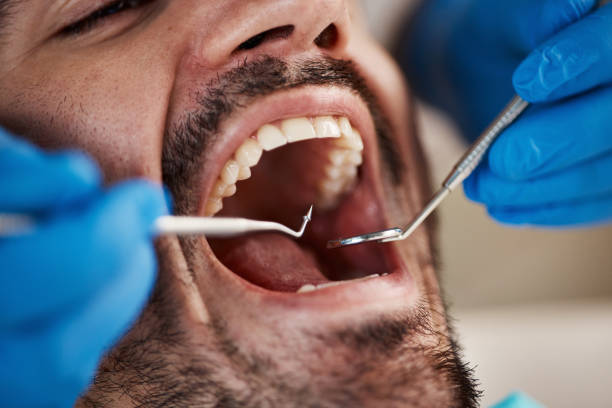 Best Knocked-Out Tooth (Avulsed Tooth) Treatment in Eunice, NM